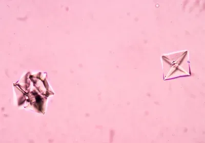 oxalate cystal rnai rna interference alnylam sirna lumasiran Oxlumo Patisiran Onpattro givosiran Givlaari galnac inclisiran